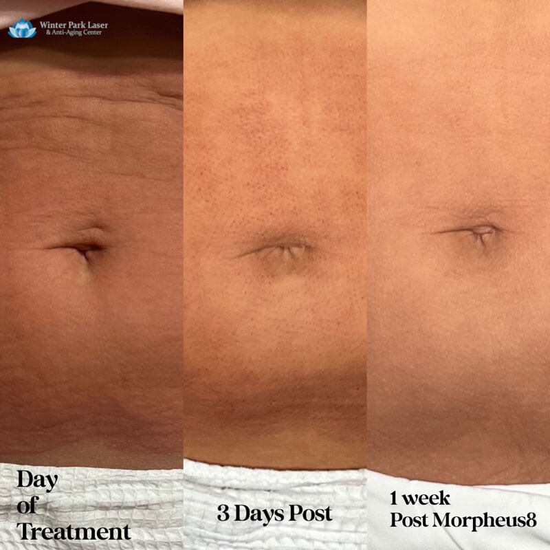 before and after treatment photos of a person's stomach with Morpheus8