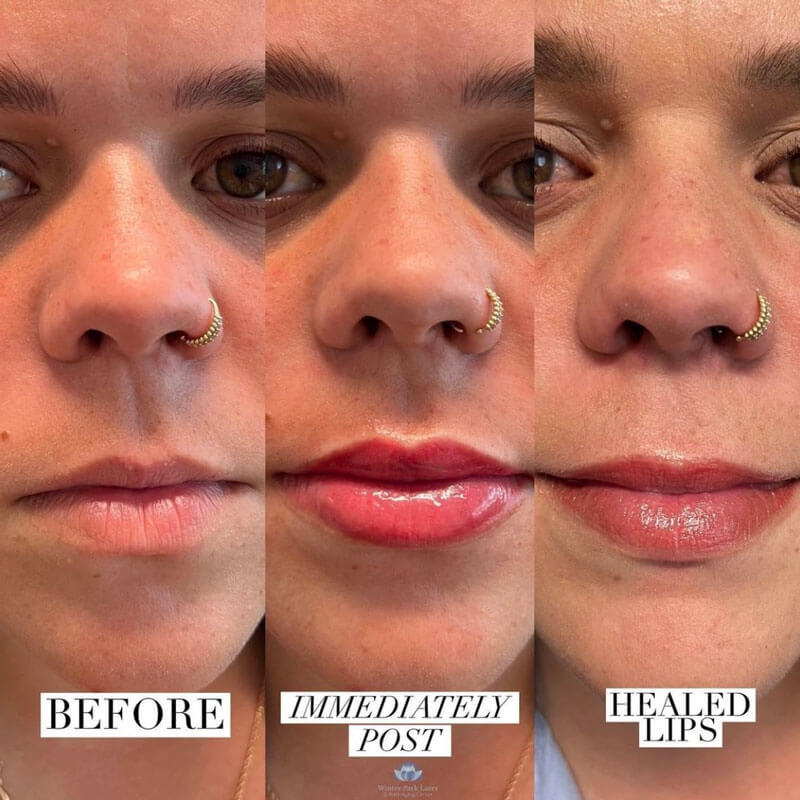 Before, immediately after, and healed lip blush treatment on woman's lips