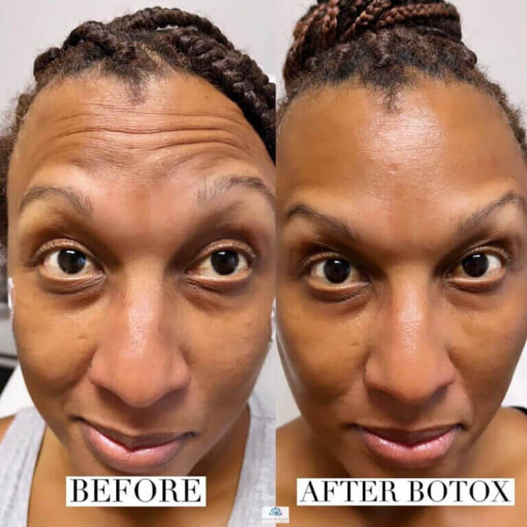 A picture depicts the before and after effects of botox treatment in Winter Park, FL